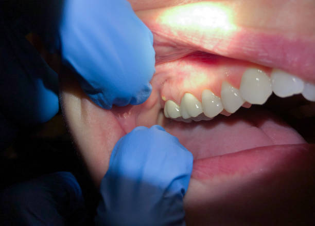 Best Emergency Wisdom Teeth Removal in Mount Pleasant, TN